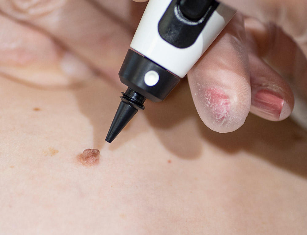 Benefits of CryoPen Treatment
