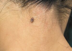 mole removal service poulton