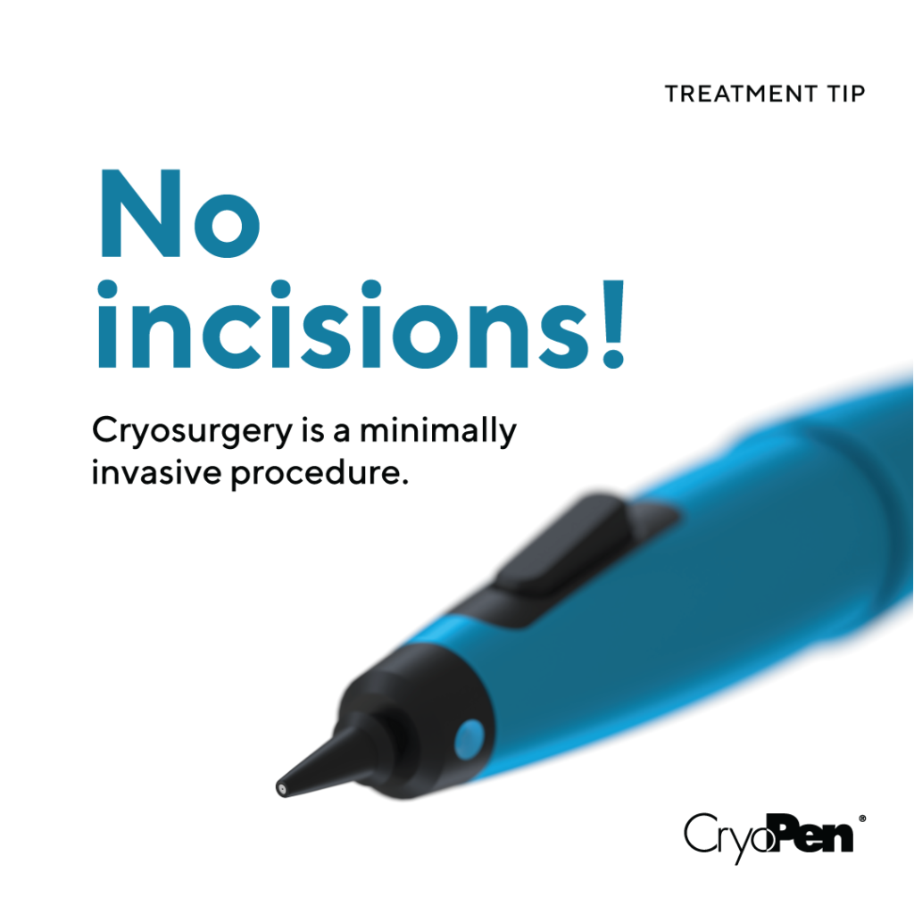 cryopen treatment poulton le fylde
