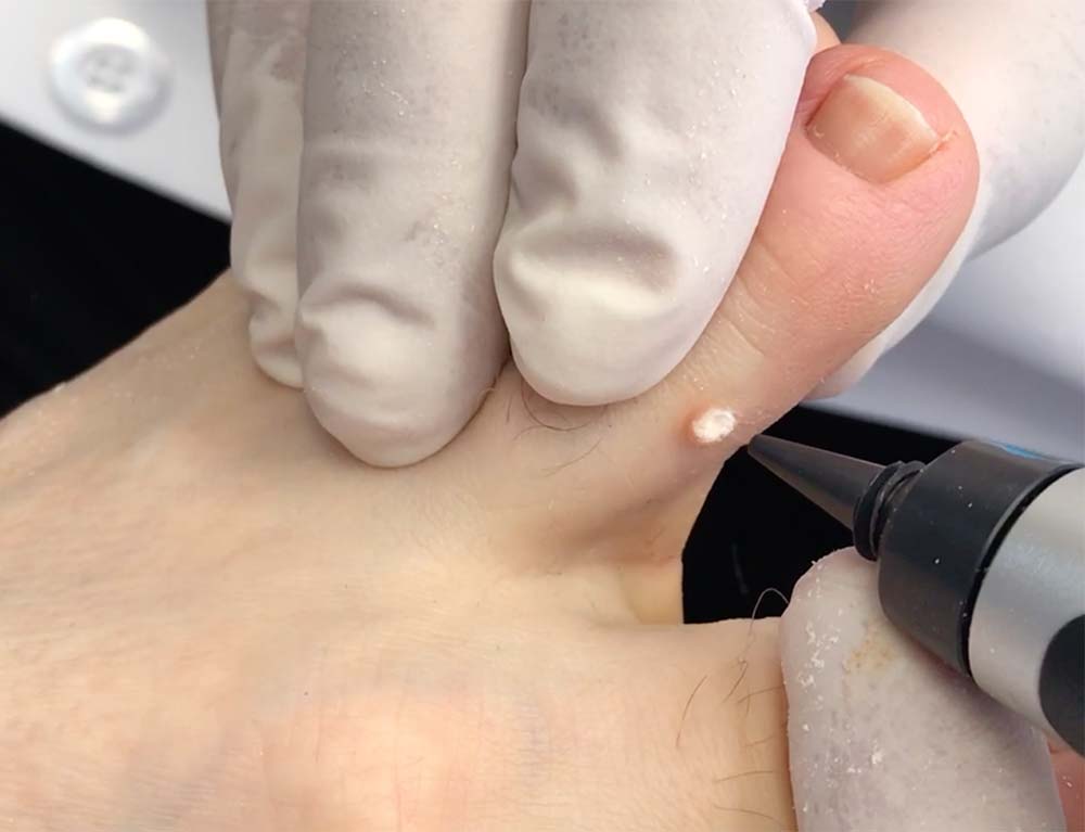 cryotherapy cryopen poulyon le fylde
