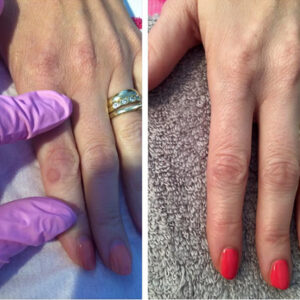 Cryotherapy Poulton