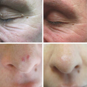 Cryotherapy Poulton