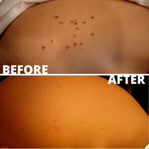 Cryotherapy Poulton
