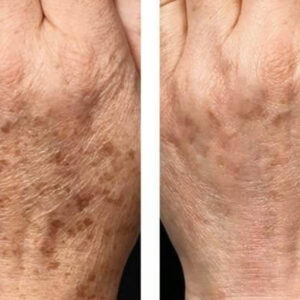 Cryotherapy Poulton