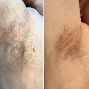 Cryotherapy Poulton