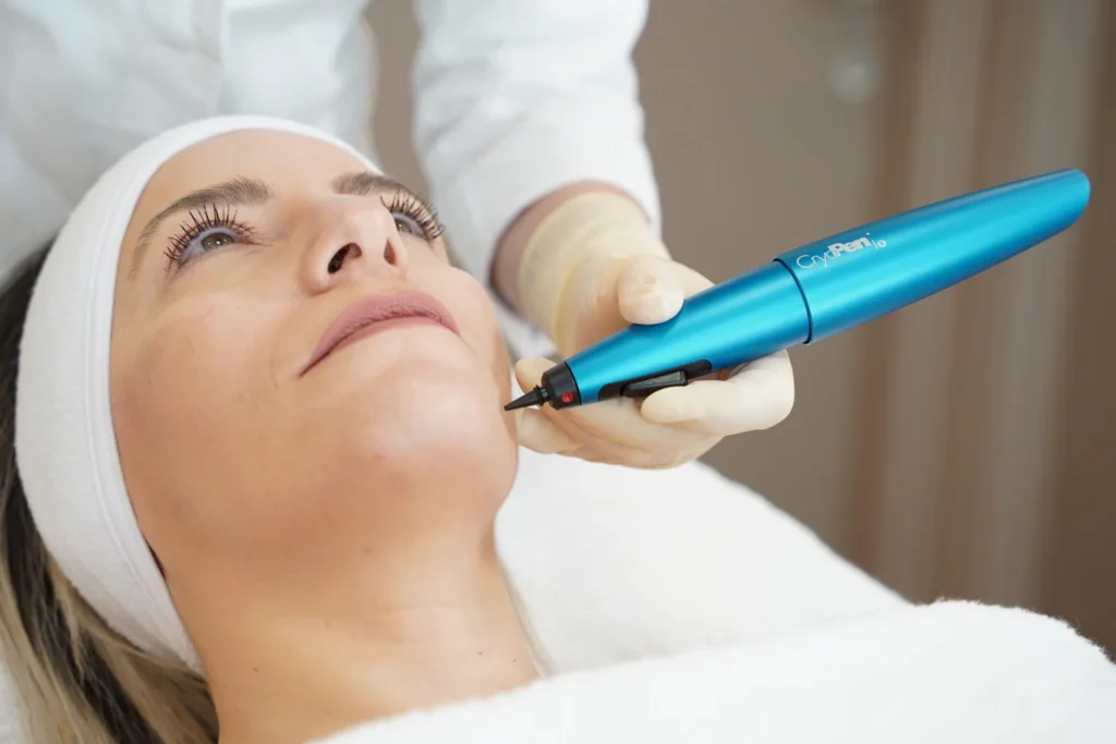 cryotherapy poulton blackpool preston