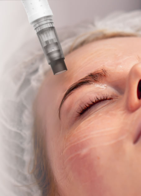 microneedling in poulton