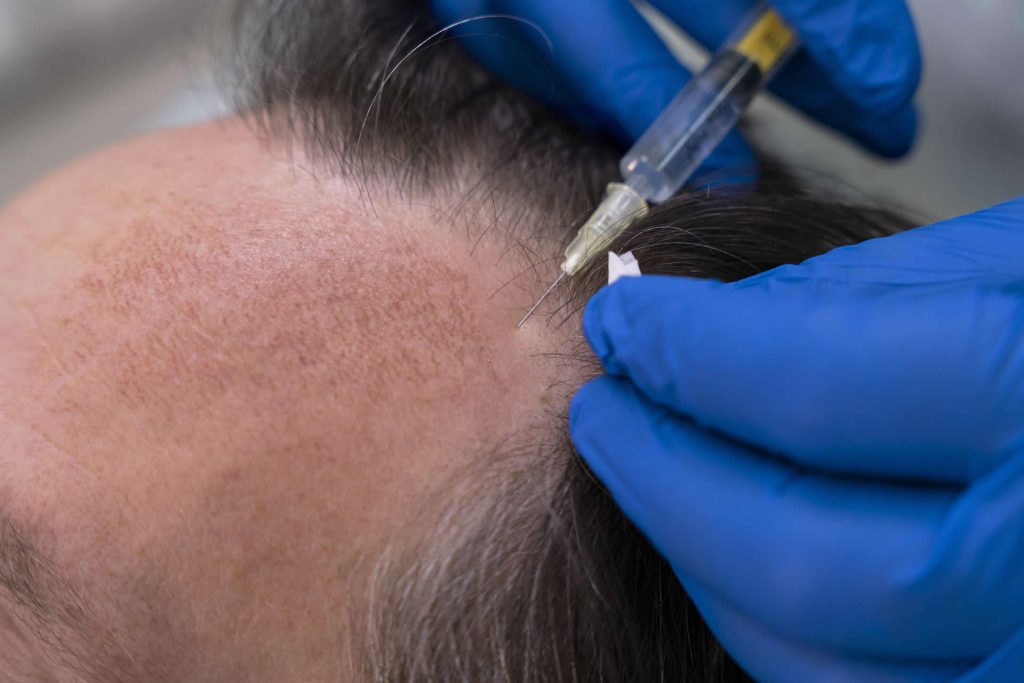 platelet rich plasma therapy (prp) Poulton