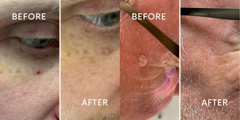 skin tag removal poulton
