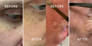 skin tag removal poulton