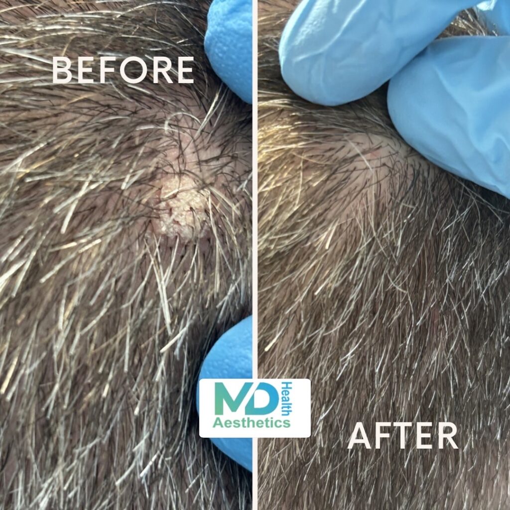 cryotherapy treatment poulton le fylde