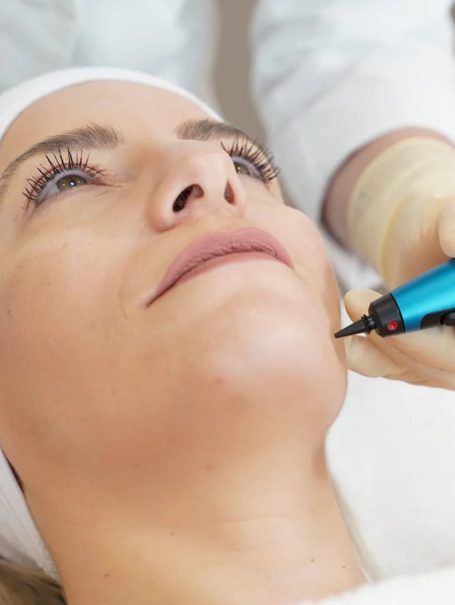 cryotherapy-skin-tag-removal