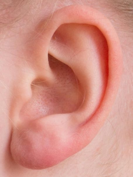 ear-screening-poulton-blackpool