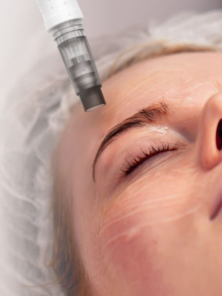 microneedling in poulton