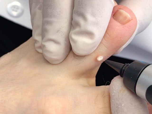 cryotherapy cryopen poulyon le fylde