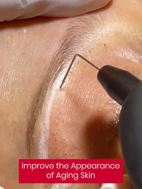 skin-tightening-plasma-poulton